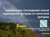 Аномальное отхождение левой коронарной артерии от легочной артерии