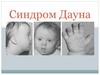Синдром Дауна