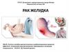 Рак желудка  (лекция 4)