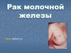 Рак молочной железы