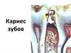 Кариес зубов