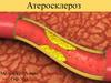 Атеросклероз