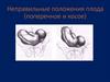 Неправильные положения плода (поперечное и косое)