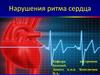 Нарушения ритма сердца