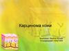 Карцинома кожи