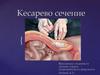 Кесарево сечение