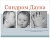 Синдром Дауна