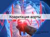 Коарктация аорты