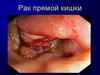 Рак прямой кишки