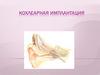 Кохлеарная имплантация